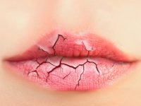Что делать, если трескаются губы и каких витаминов не хватает